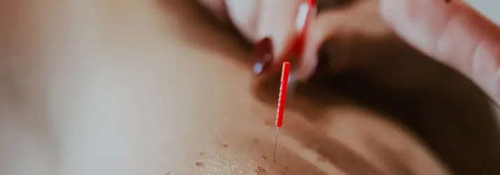 Acupuncture treatment being performed on a patient's back and shoulders